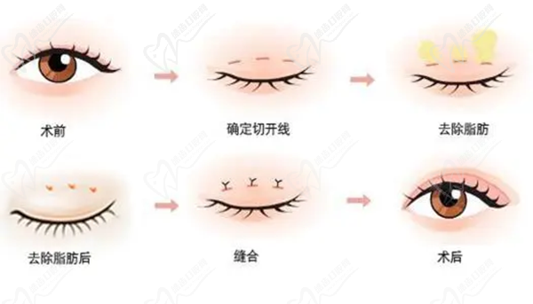 王衡健雙眼皮修復