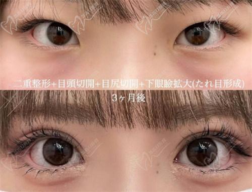 北京豐聯(lián)麗格醫(yī)療美容師麗麗修復(fù)雙眼皮怎么樣？