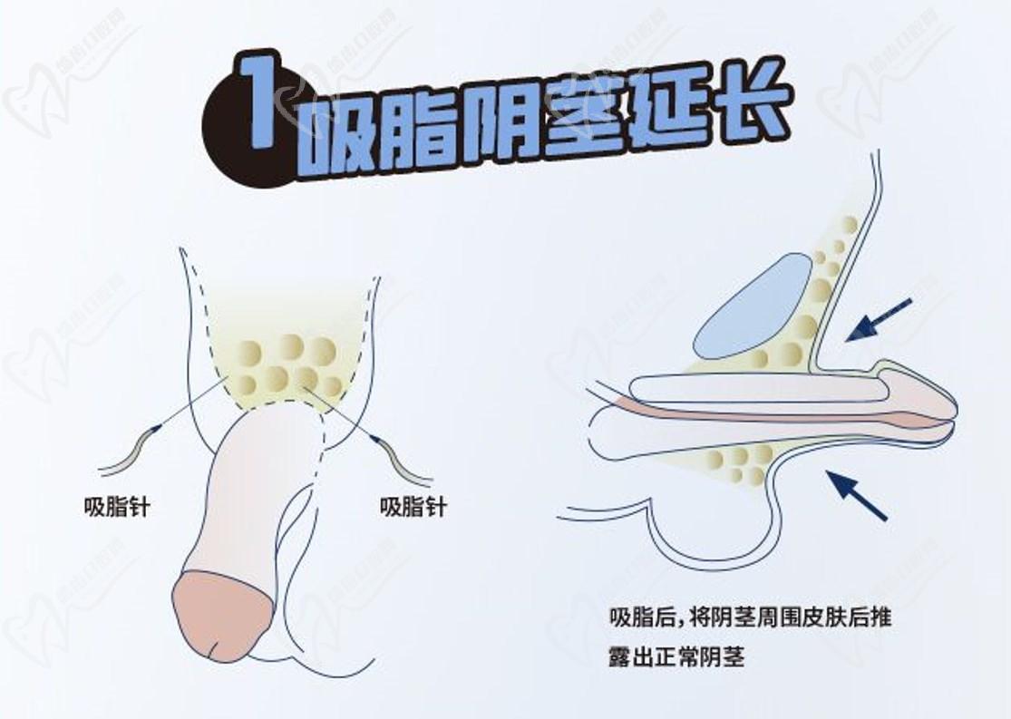 李世榮延長手術為什么那么貴