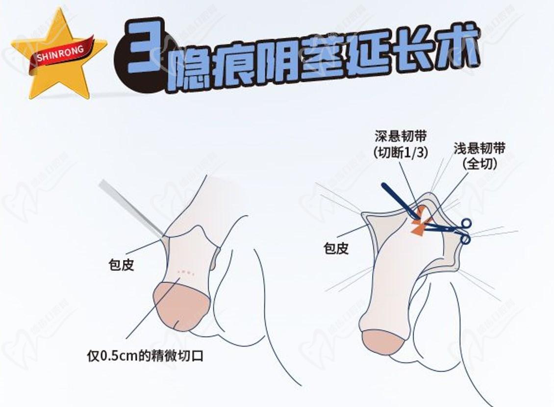 李世榮延長手術之所以厲 害