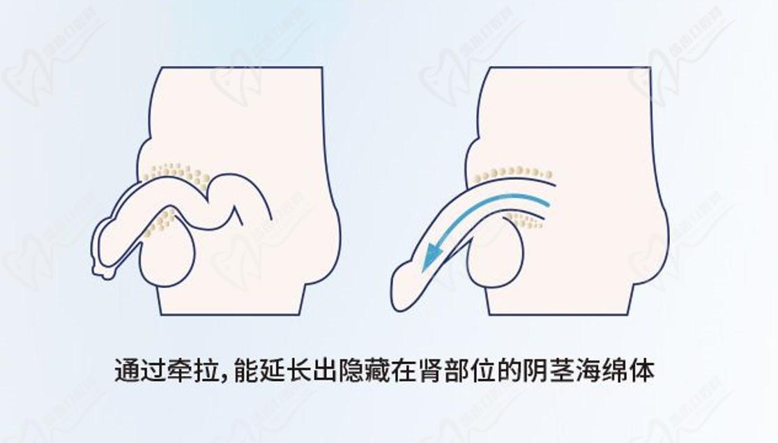 李世榮延長手術之所以厲 害