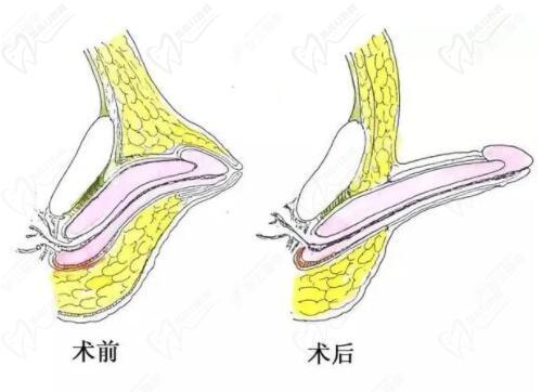 李世榮的延長(zhǎng)術(shù)采用"三層遞進(jìn)減張縫合"技術(shù)
