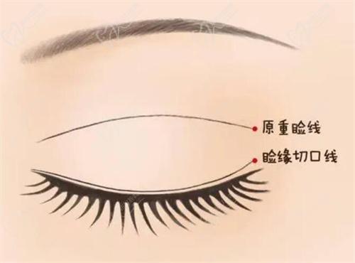 三、影響北京豐聯(lián)麗格整形醫(yī)院做雙眼皮價(jià)格的因素