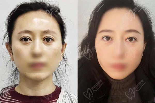 上海張?jiān)娙粜迯?fù)雙眼皮內(nèi)眼角怎么樣