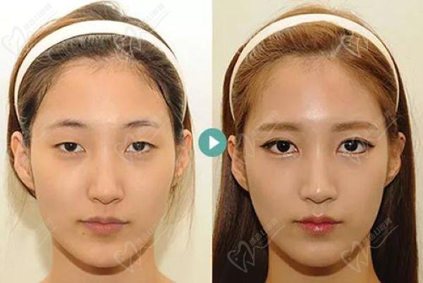 上海張?jiān)娙粜迯?fù)雙眼皮內(nèi)眼角真實(shí)實(shí)例