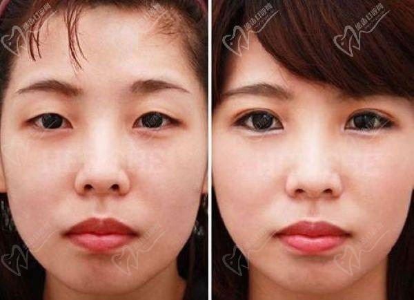 上海張?jiān)娙粜迯?fù)雙眼皮內(nèi)眼角價(jià)格多少錢
