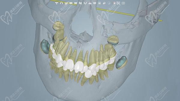 牙科矯正牙齒收費價目表