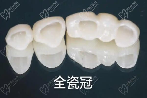 橋架材質(zhì)有哪些分類？純鈦橋架更值得選嗎