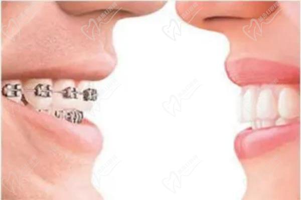 怎么區(qū)分正畸mbt與roth托槽？對(duì)比兩者區(qū)別來(lái)看哪個(gè)好附價(jià)格