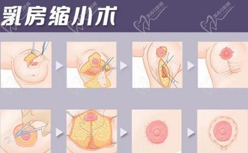 重慶劉正茂醫(yī)生縮胸怎么樣？