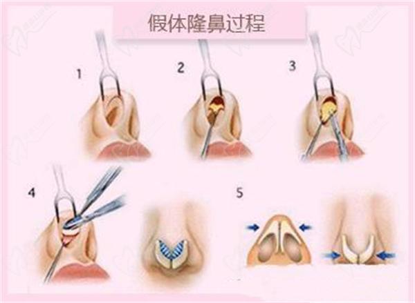 瞿健隆鼻