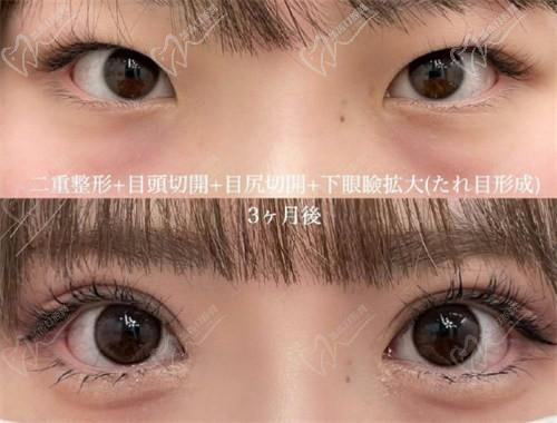 北京豐聯(lián)麗格醫(yī)療美容師麗麗修復雙眼皮怎么樣？肉條眼修復解決假寬深疤痕更隱形