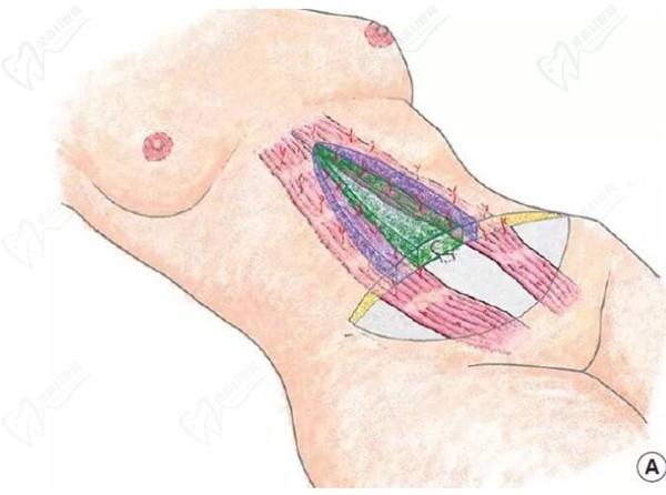 成都張航做腹壁整形靠譜，四川現(xiàn)代醫(yī)院張航腹部拉皮技術(shù)口碑不錯(cuò)|松弛肚皮變平整無疤痕更自然
