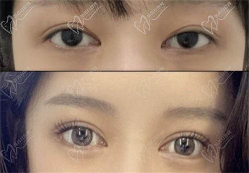 師麗麗的案例可信嗎?是不是營銷出來的?師麗麗雙眼皮修復+內眼角修復案例