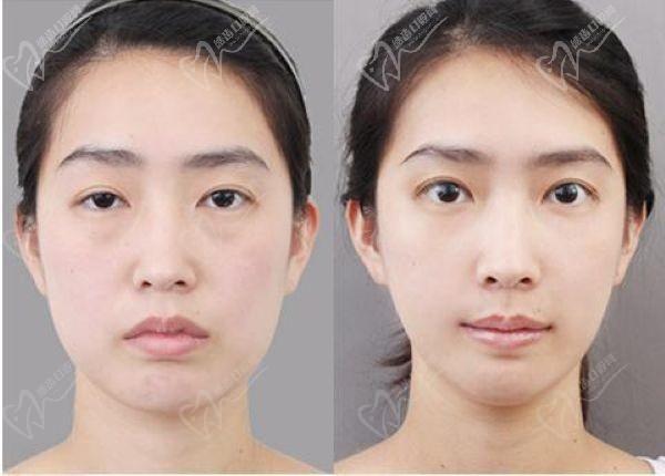 上海張詩若修復雙眼皮內眼角怎么樣？技術優(yōu)勢+真實實例+收費一覽