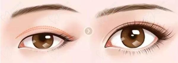 上海杜園園做眼睛失敗修復病例眾多，技術靠譜案例多，高難度眼修復難題不在話下